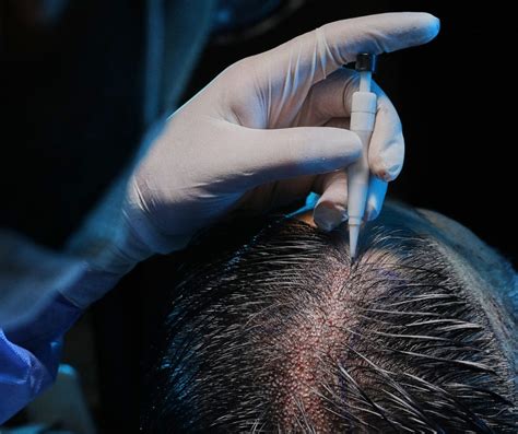 De Diverse Methoden Van Haartransplantatie DHI