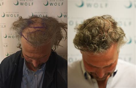 Haartransplantatie DHI: De Beste Keuze Voor Jou?