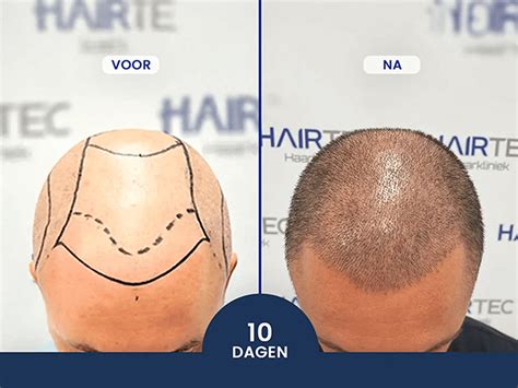 Haartransplantatie Kosten: Regionale Verschillen