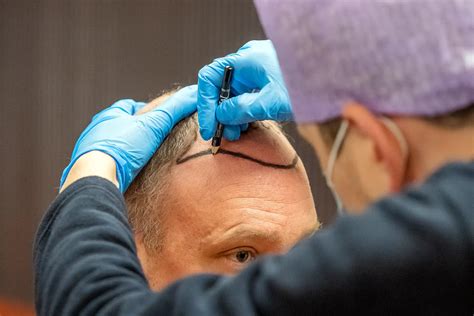Saffier FUE: De Innovatieve Haartransplantatietechniek